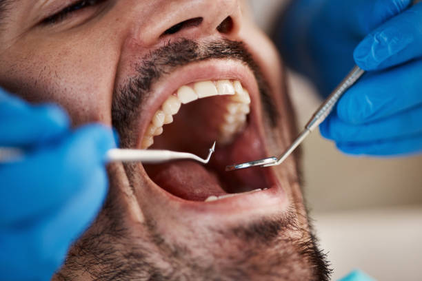 Best Emergency Dentist for Lost Fillings or Crowns in Eldorado, TX